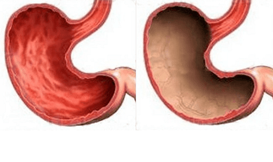 Ulcers, gastritis, cancer and other stomach pathologies (on the right) caused by alcohol